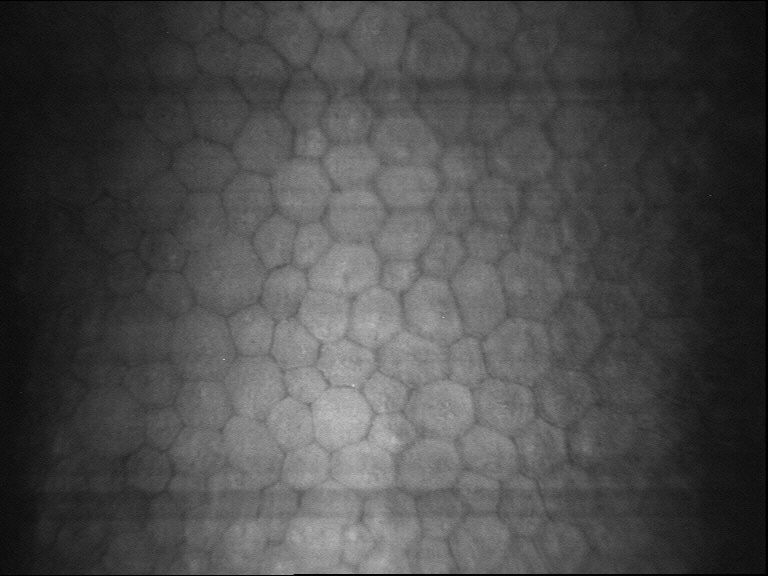 Microscopía especular confocal normal