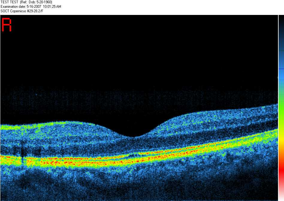 Imagen normal de la zona macular mediante OCT.